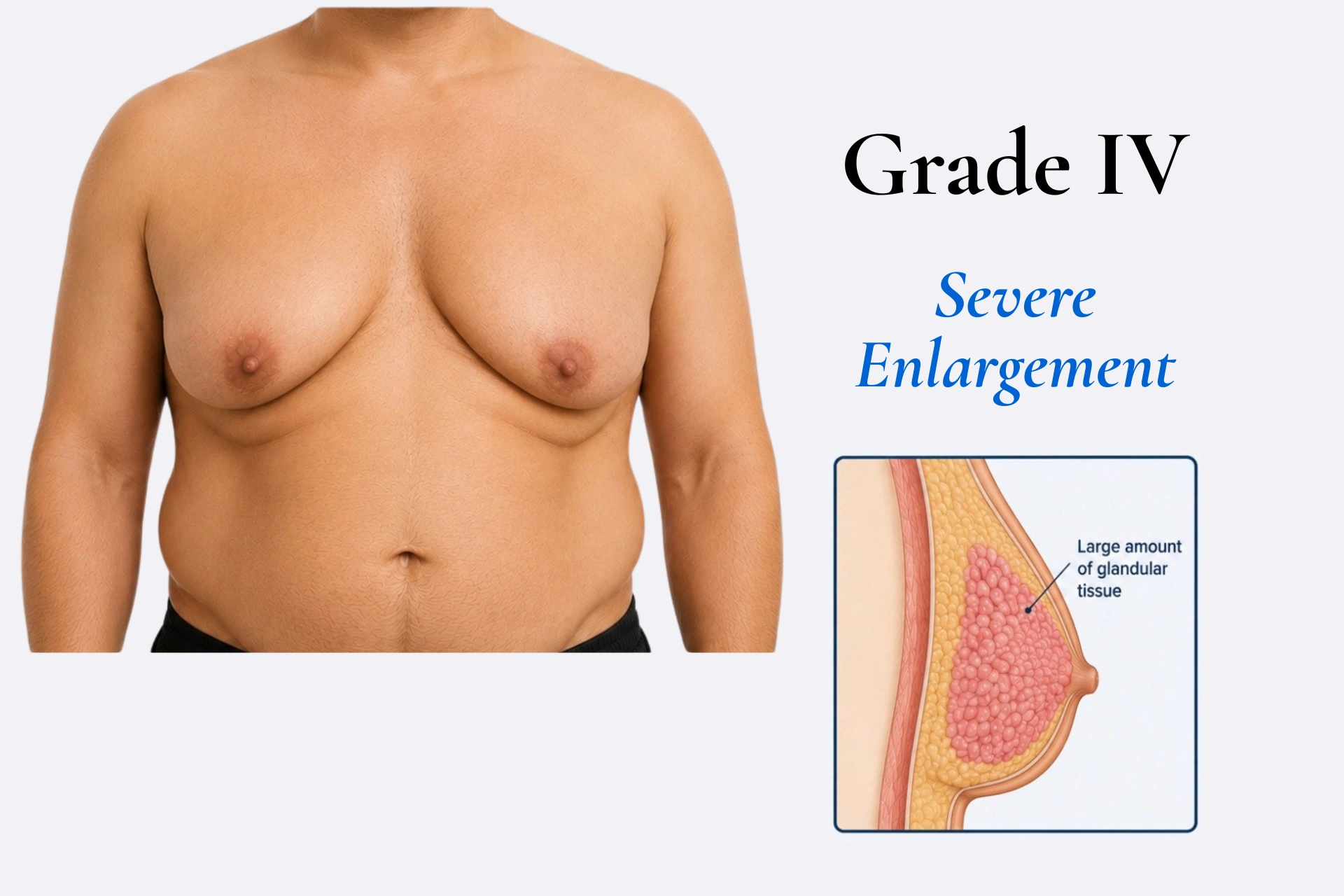 Grade I